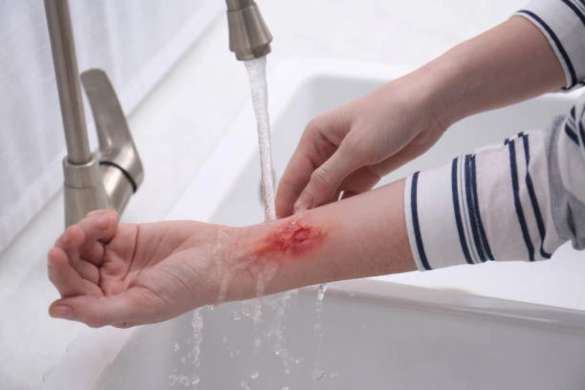 Burn injury lawyer