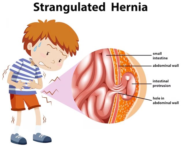 california hernia mesh lawyer
