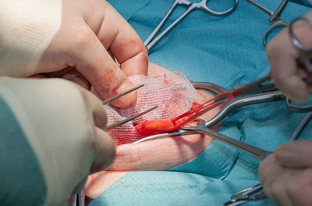 best lawyer for hernia mesh lawsuit
