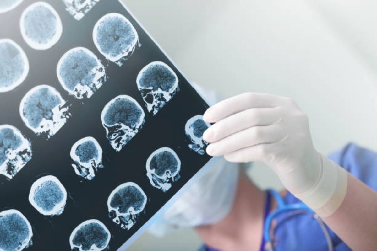 brain injury lawyer