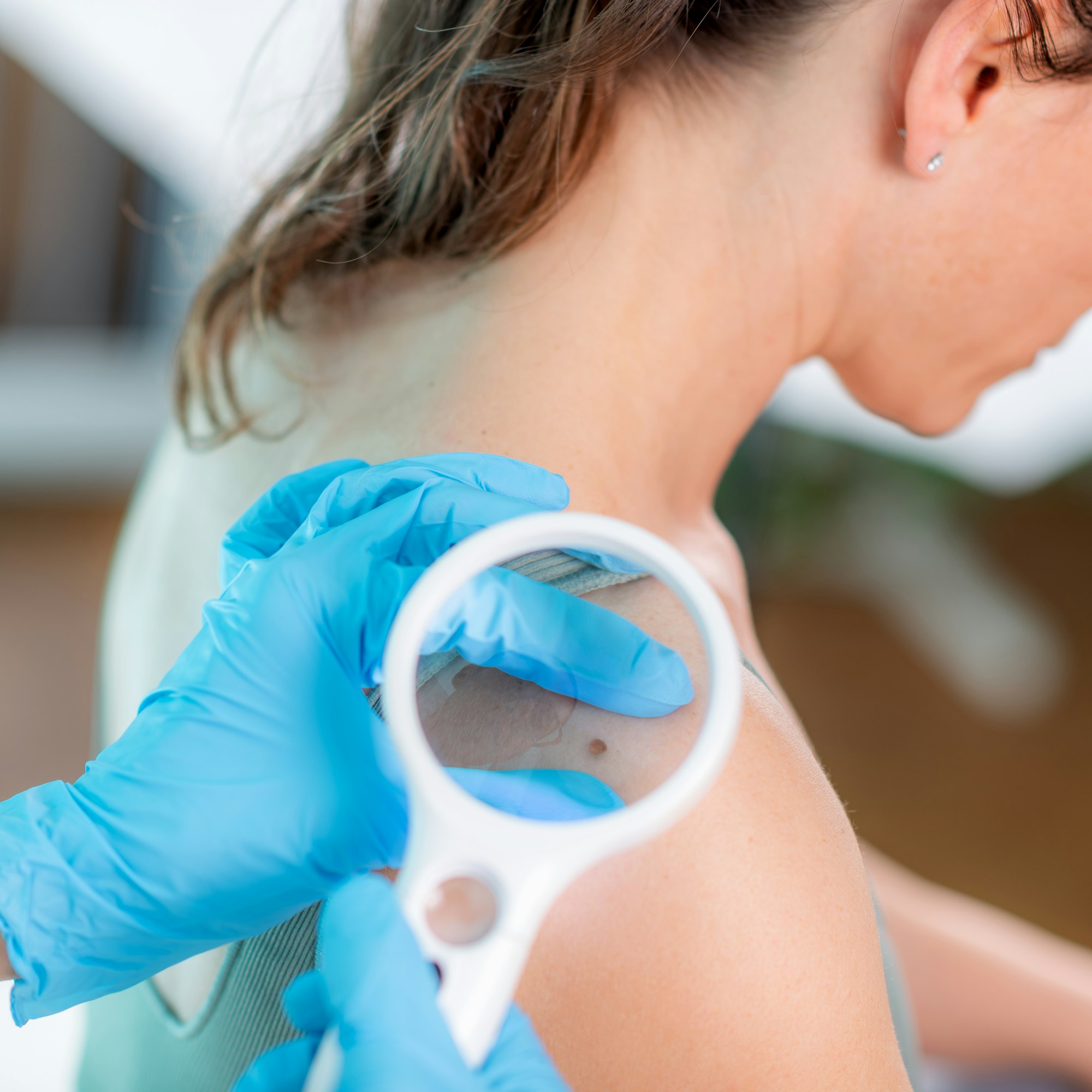Know Your Skin: How to Identify a Cancerous Mole