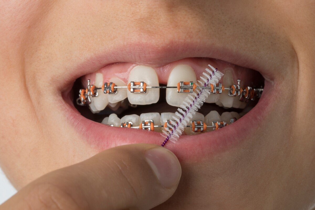 dental insurance that covers braces