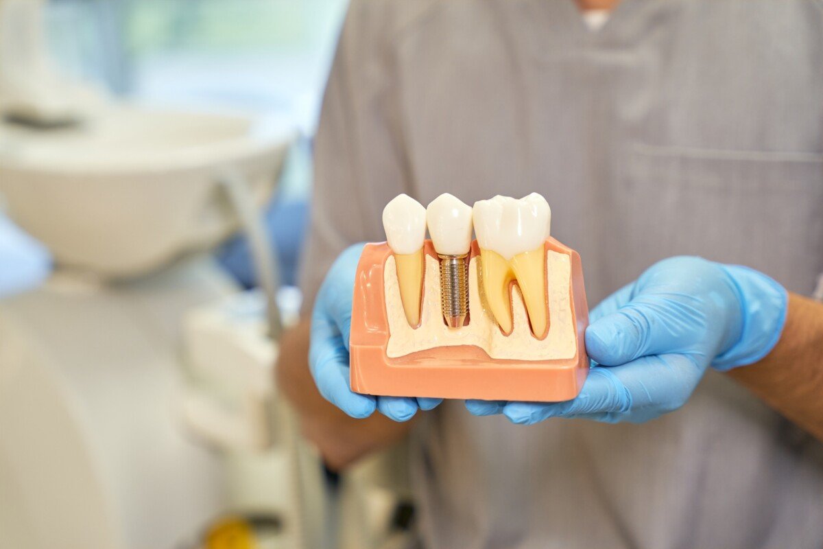 does aetna medicare cover dental implants
