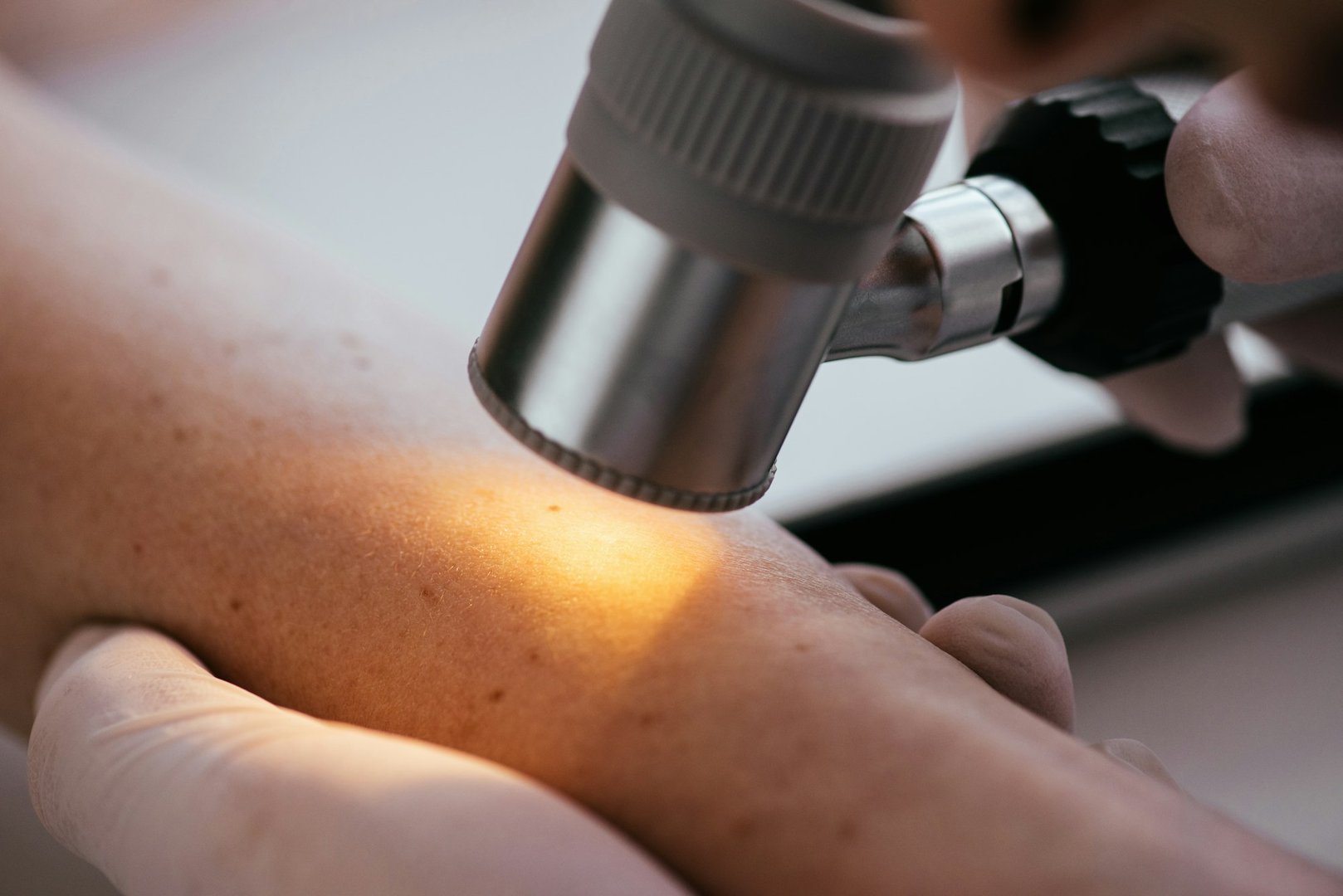 Does Medicare Cover Melanoma Screenings