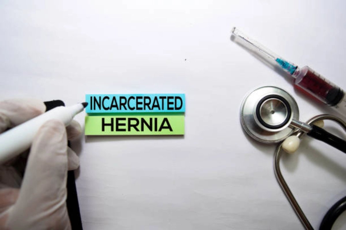 Hernia Mesh Lawsuit Timeline: How Long Does It Take