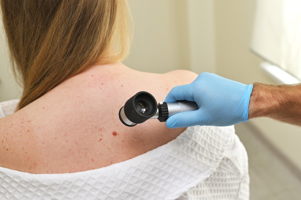 Skin Cancer
