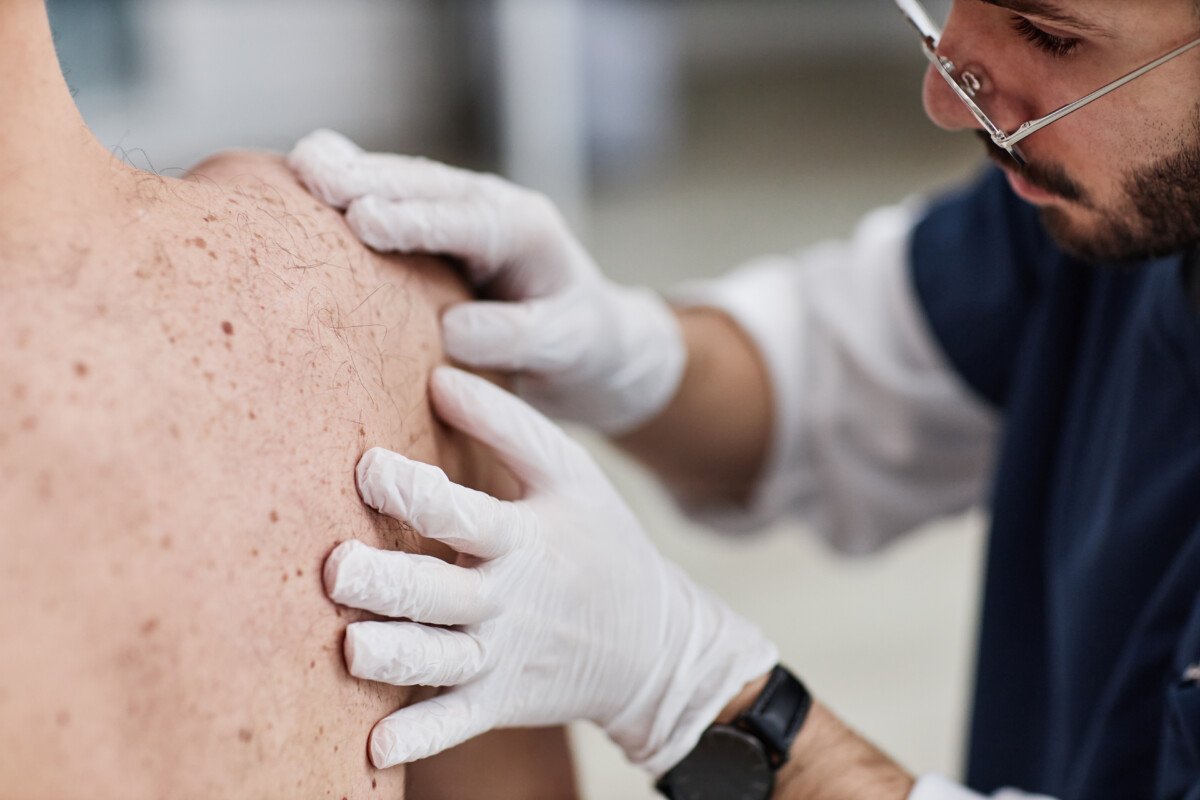 Skin Cancer Symptoms