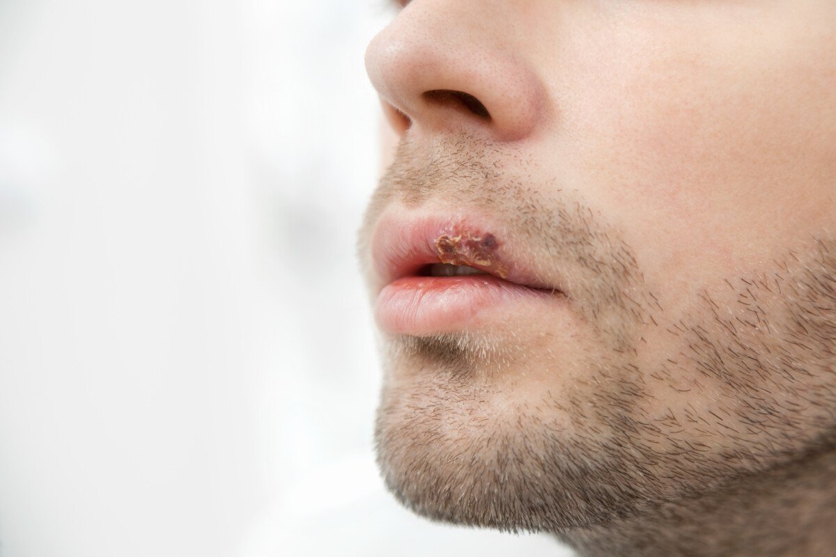 Lip Cancer