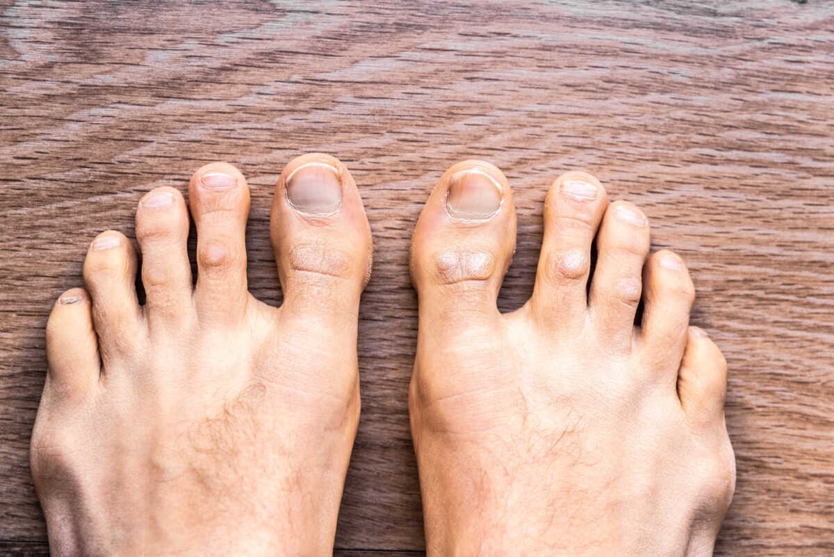 Understanding Psoriasis on Feet: Symptoms, Causes, and Treatment Options