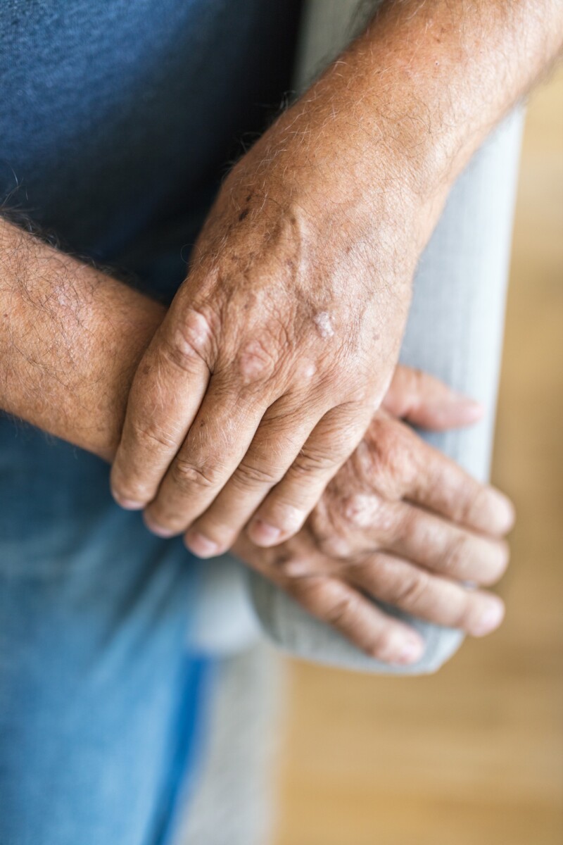 Comprehensive Guide to Psoriasis Treatment: Understanding Options and Lifestyle Changes
