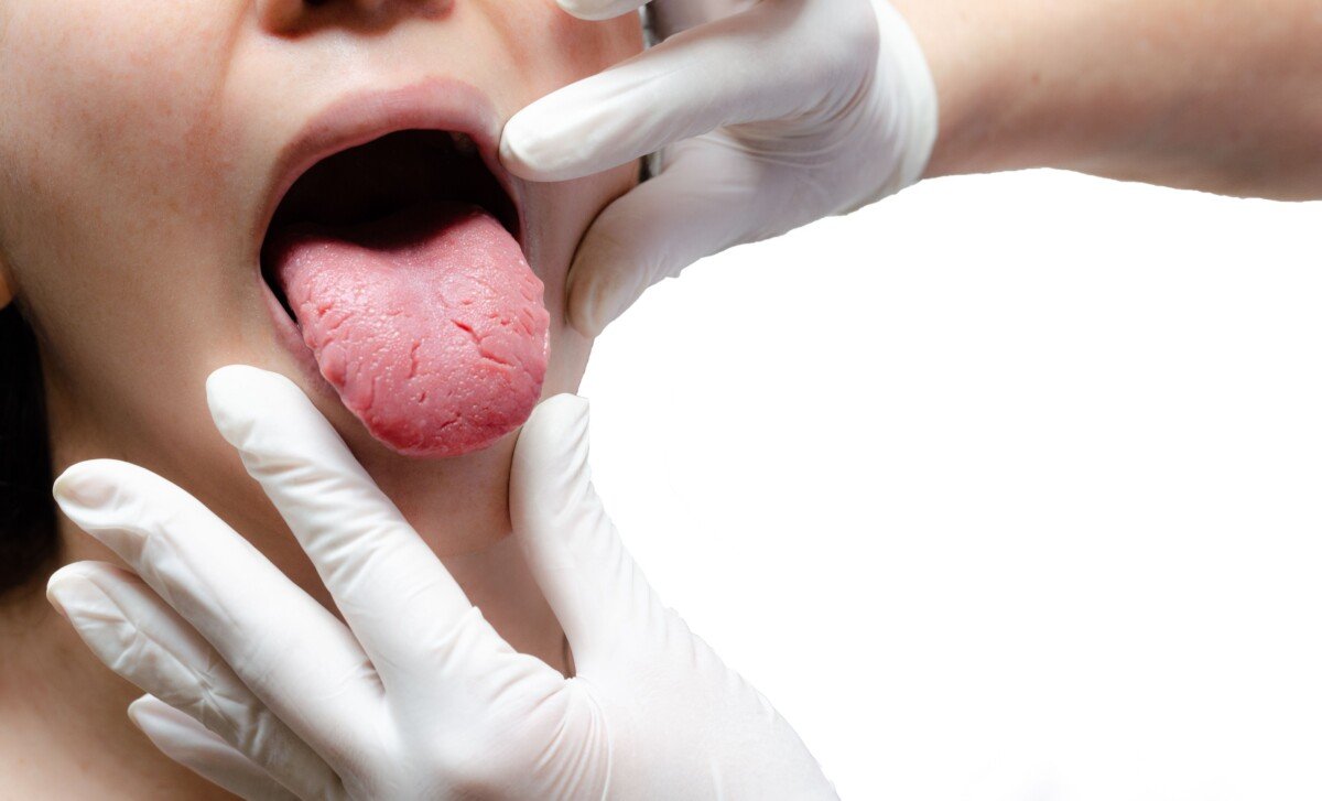 tongue aids symptoms